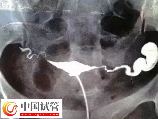 做试管输卵管积水有没有影响(图1)
