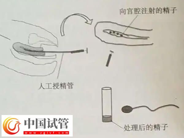 吉安市妇幼保健院人工授精的治疗流程是怎么样的？(图3)