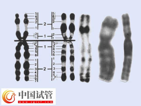做试管2号染色体重复有什么影响(图1)