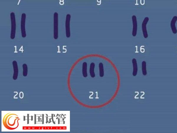 22号染色体异常还能不能要孩子(图1)